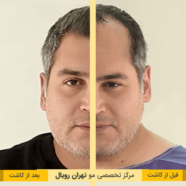 تصاویر قبل و بعد کاشت مو